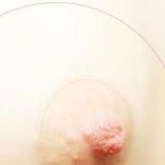Stress et cancer du sein